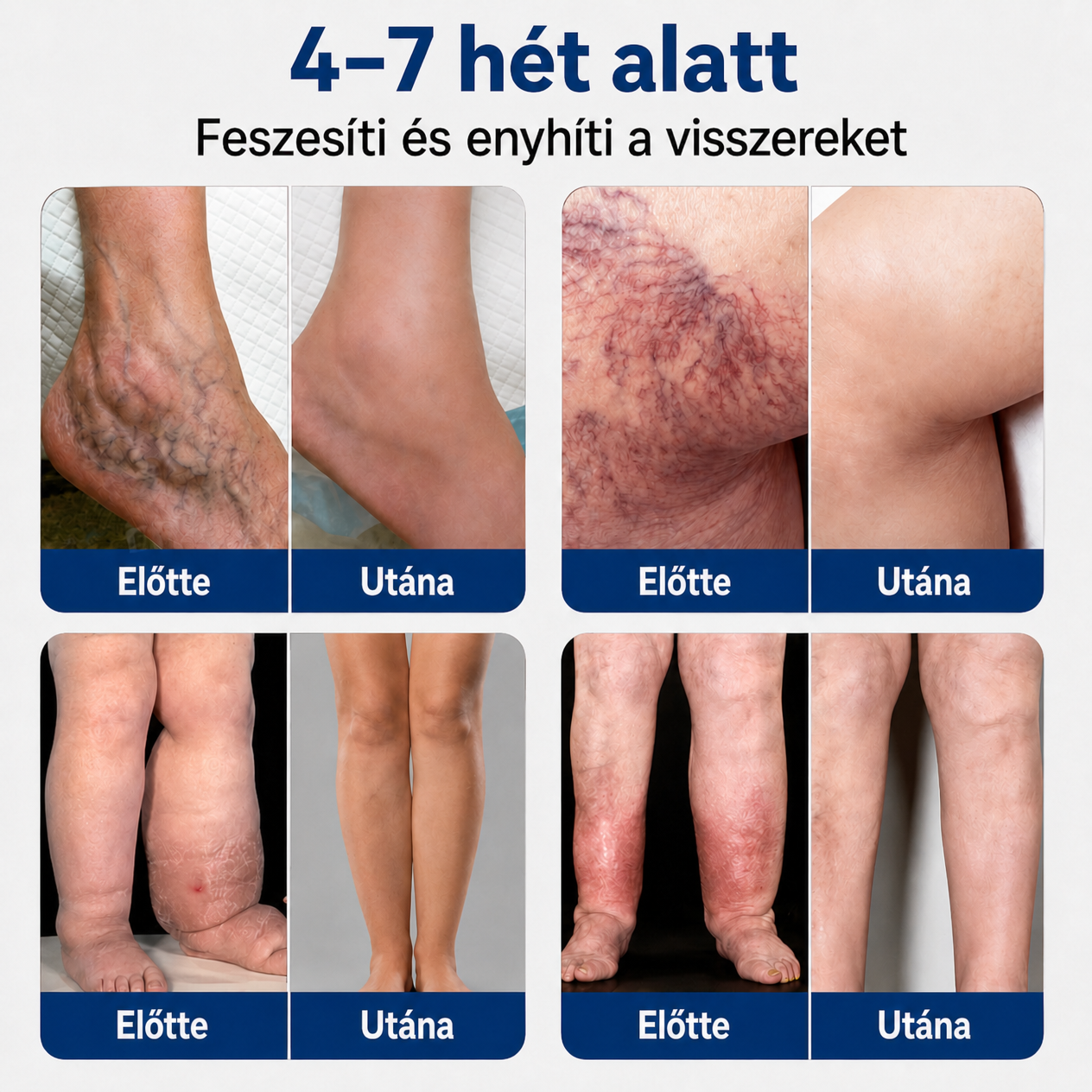 RZXEA™ Fortschrittliches Mikronadel Venen Reparatur Pflaster